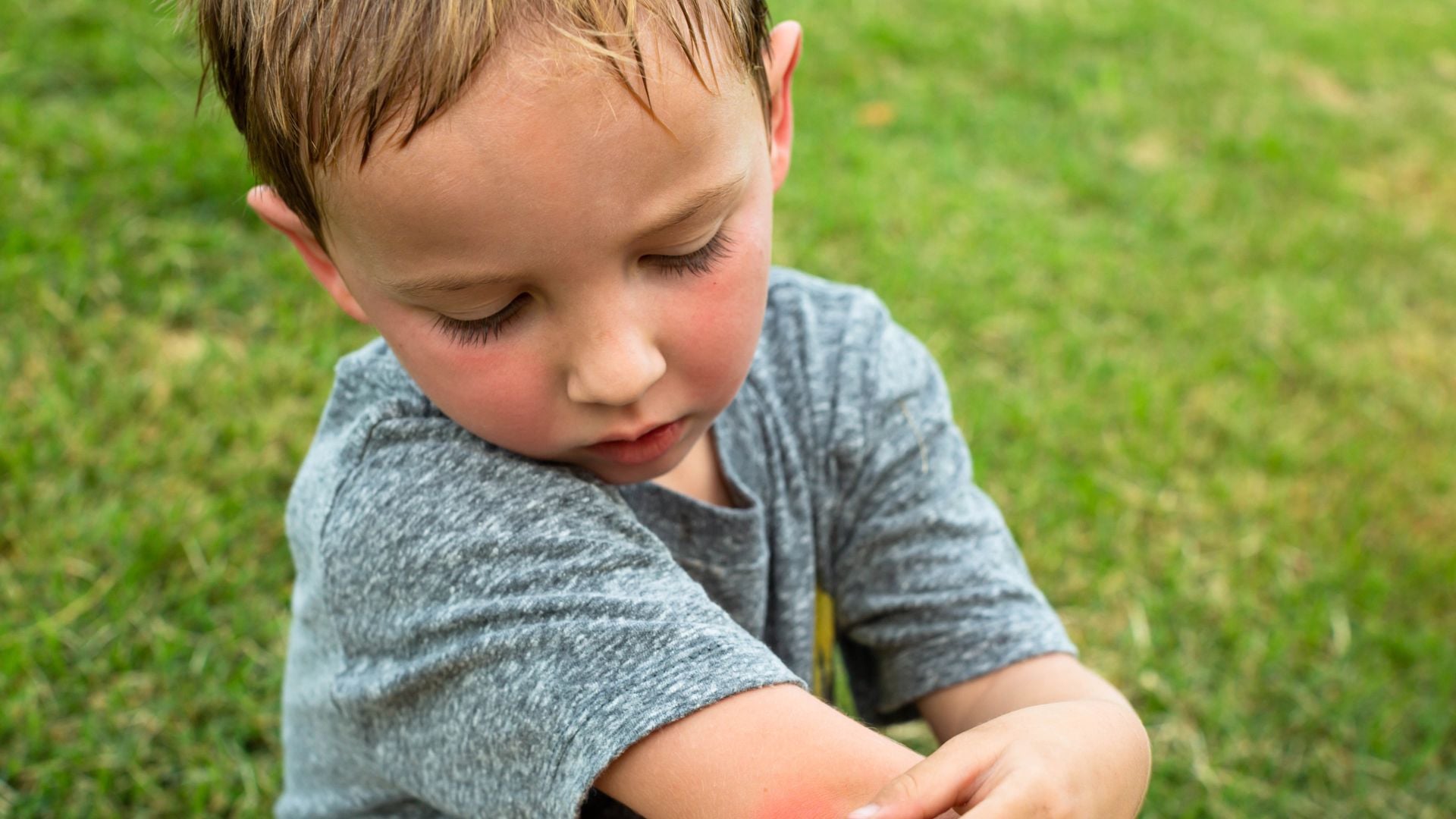 Can bee stings lead to future allergic reactions?